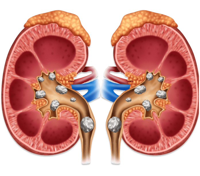 Kidney Stone Treatment and Care