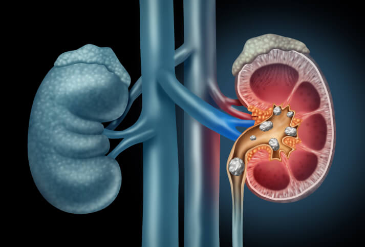 Factors That Increase The Risk of Developing Urinary Stones